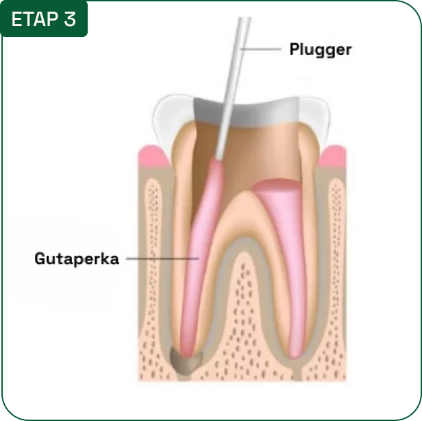 Etap 3: wypełnianie kanałów gutaperką (plugger) — schemat