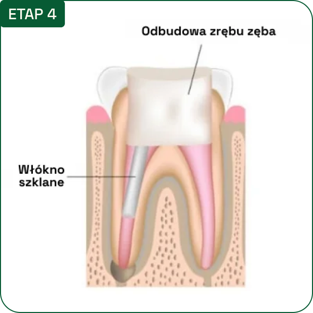 Etap 4: odbudowa zrębu zęba na włóknie szklanym — schemat