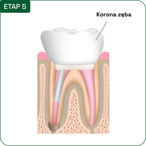 Etap 5: korona zęba — schemat